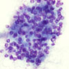 Mikroskopbild på Pneumocystis jiroveci cystklase.